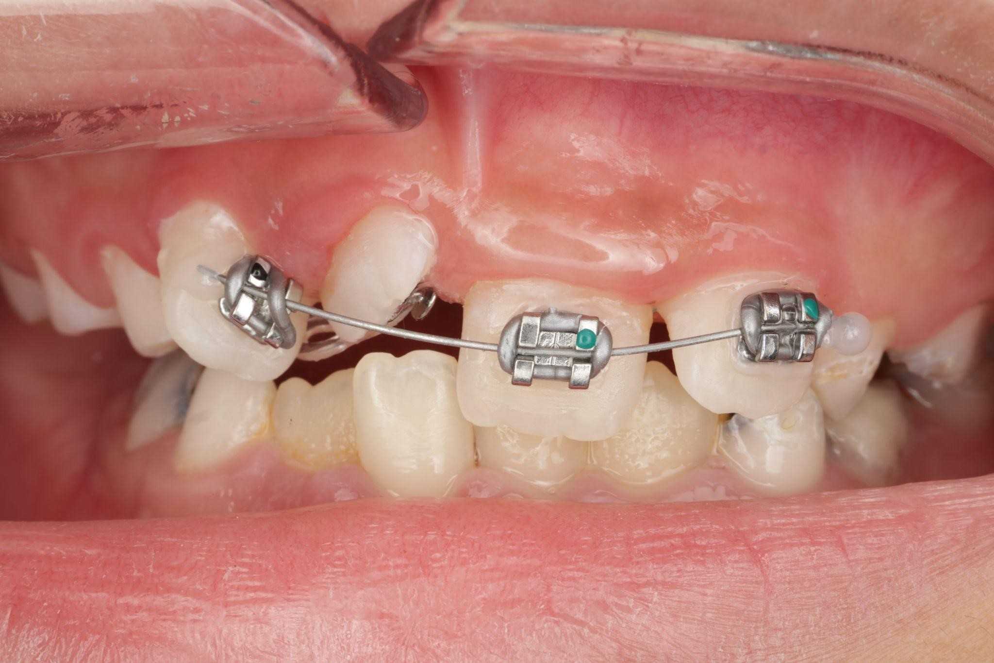 Top 5 nha khoa niềng răng uy tín ở Huế: An tâm từ tư vấn đến kết quả